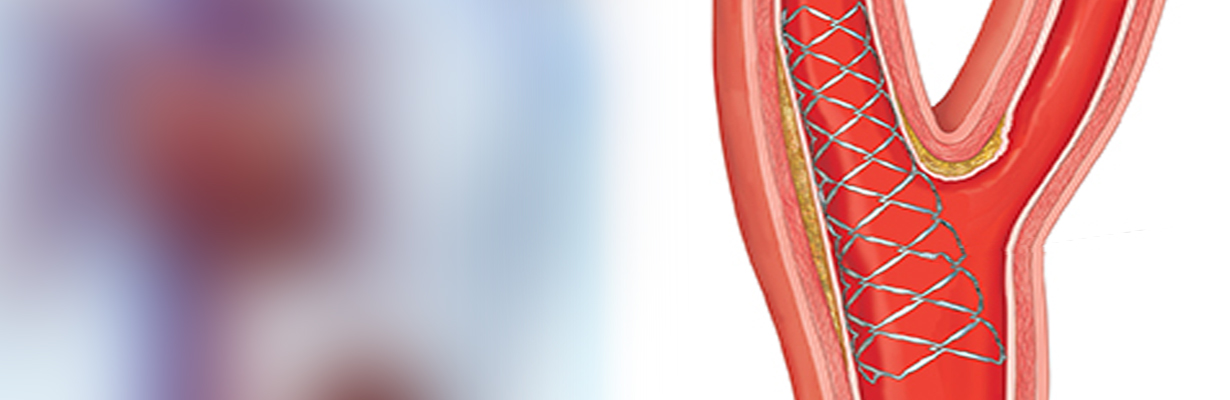 Can primary PCI be done along with carotid angioplasty?