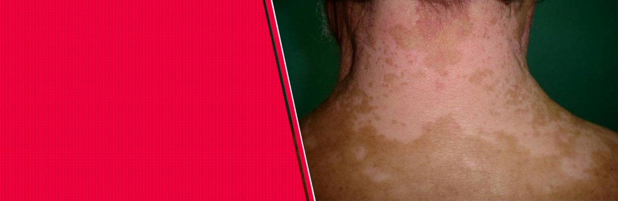 Can Vitiligo go for a remission?