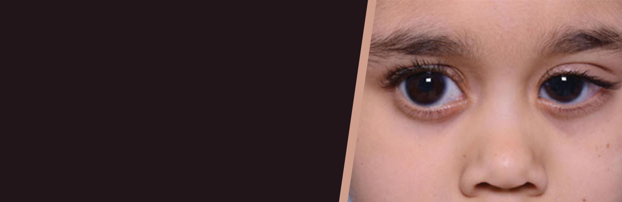 Can glaucoma occur in children?