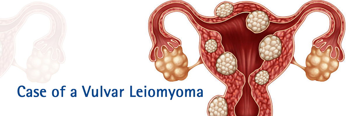 Case of a Vulvar Leiomyoma