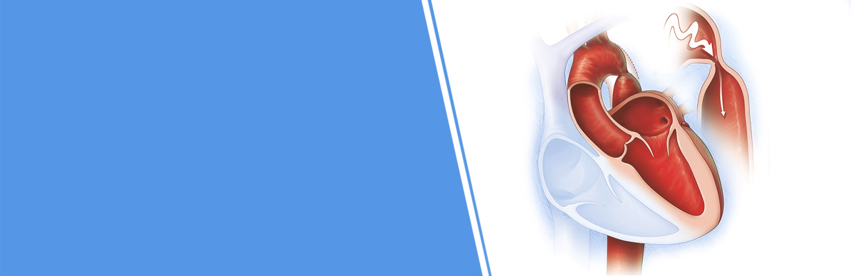 How should we diagnose coarctation of aorta?