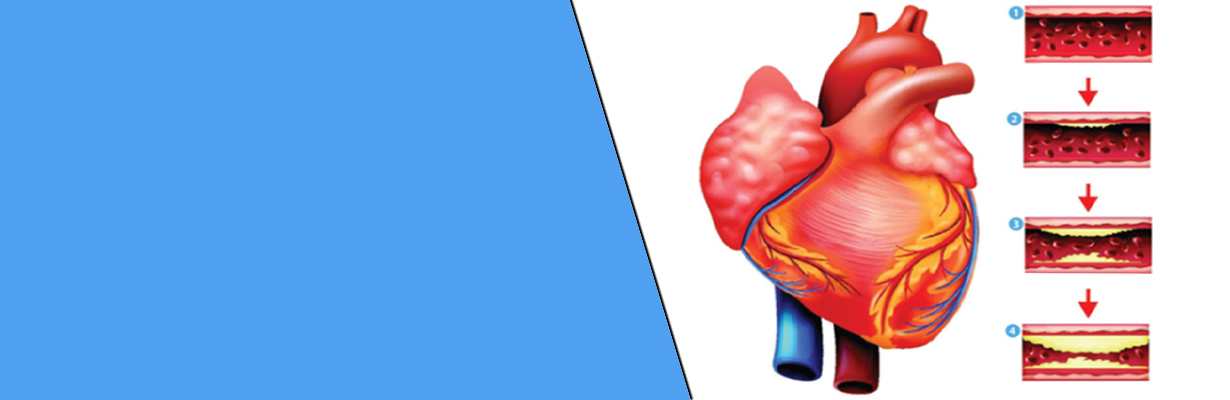 Differentiate progressive and non-progressive coronary artery disease?