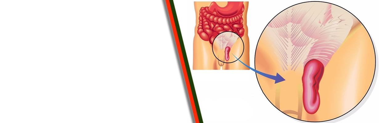 Discuss hernia and its management?