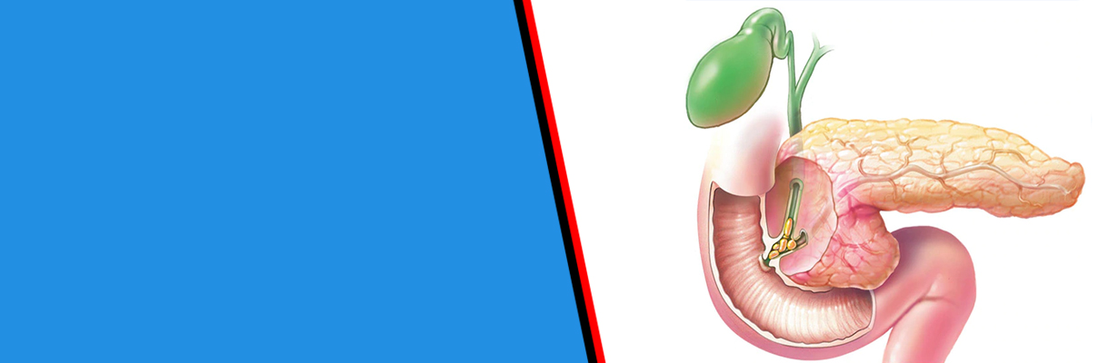 Discuss the management of asymptomatic gallstones in the diabetic patient?
