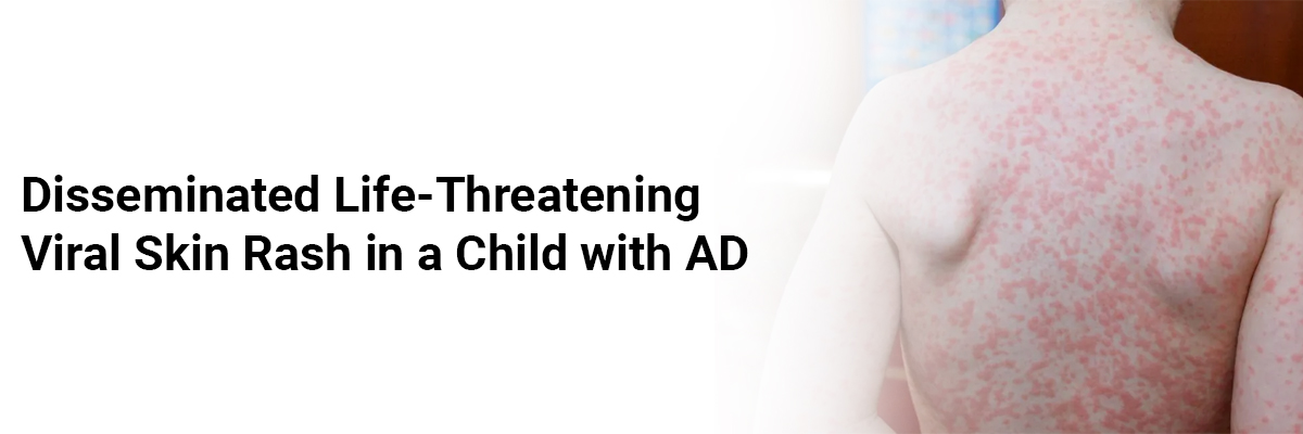 Disseminated life-threatening viral skin rash in a child with AD