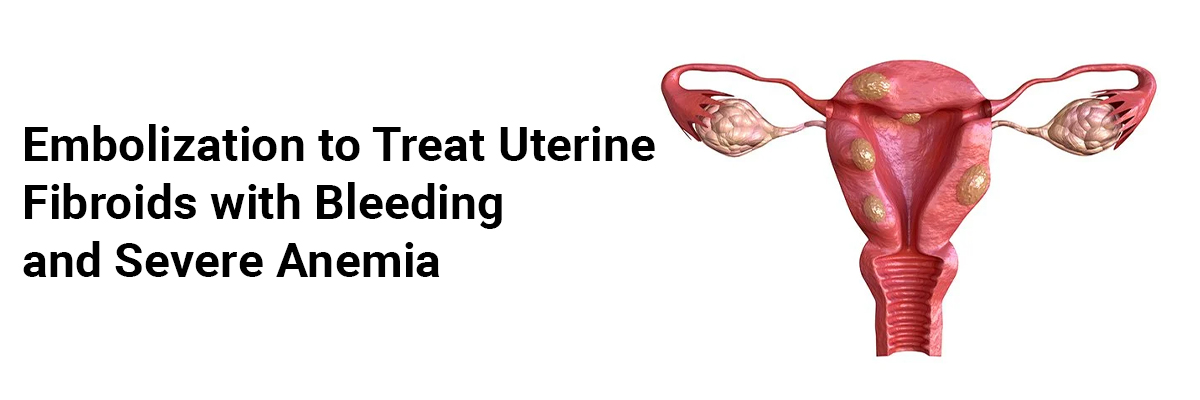 Embolization to Treat Uterine Fibroids with Bleeding and Severe Anemia