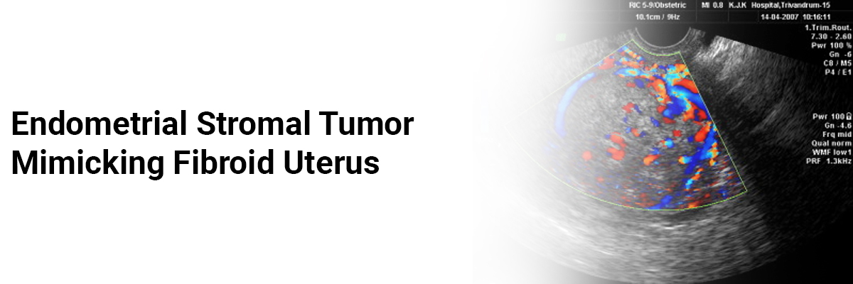 Endometrial Stromal Tumor Mimicking Fibroid Uterus 