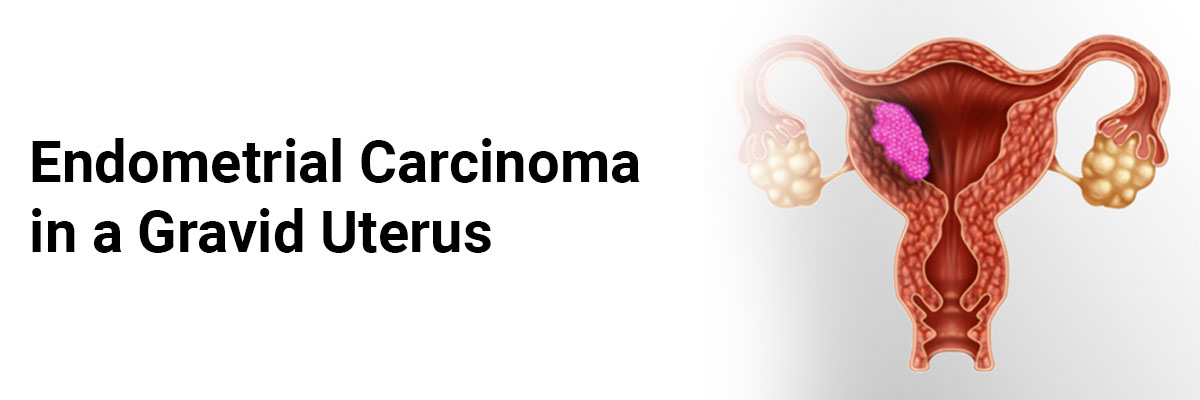 Endometrial carcinoma in a gravid uterus