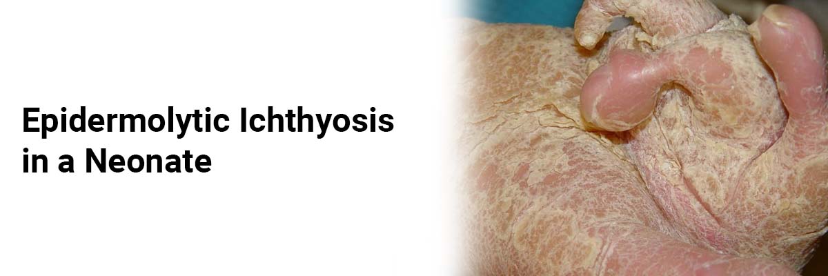 Epidermolytic Ichthyosis in a Neonate