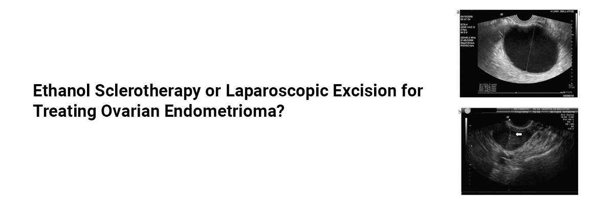 Ethanol Sclerotherapy OR Laparoscopic Excision for Treating Ovarian Endometrioma?