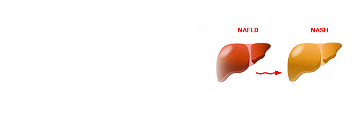 Understanding NASH and NAFLD: How do you differentiate?