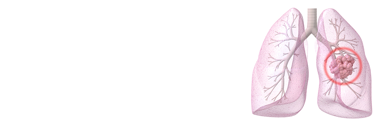 What is Lung Cancer? | Types of Lung Cancer |  Symptoms and causes