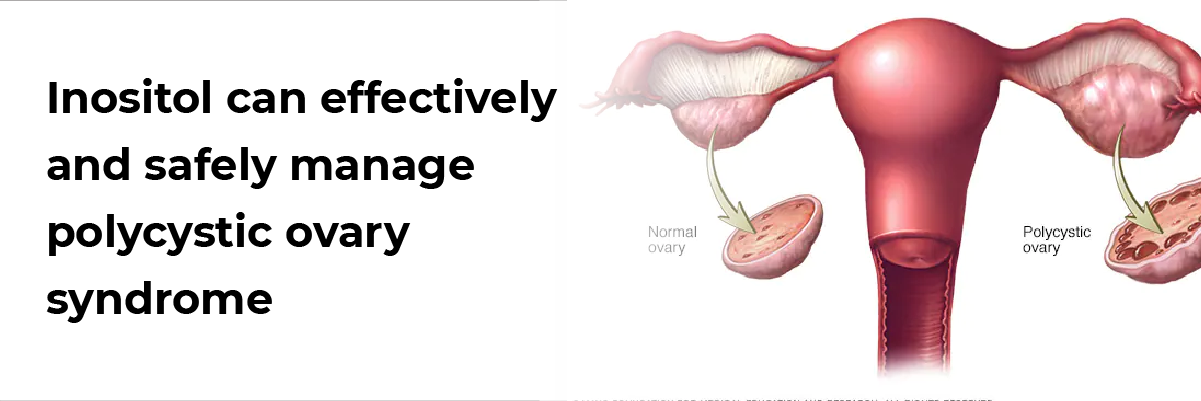 Inositol can effectively and safely manage polycystic ovary syndrome