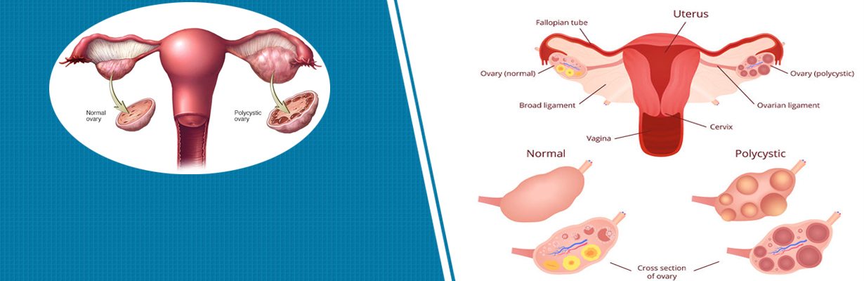 How PCOS is different from metabolic syndrome?