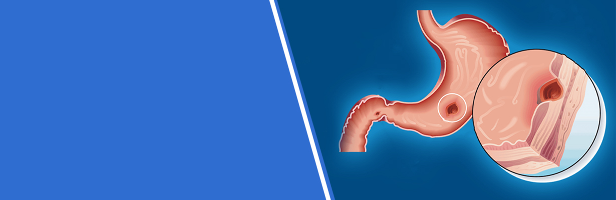 How can one evaluate peptic ulcer disease?