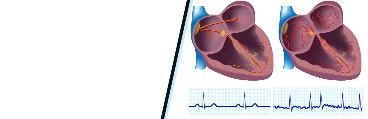 How common is atrial fibrillation in underlying rheumatic heart disease?
