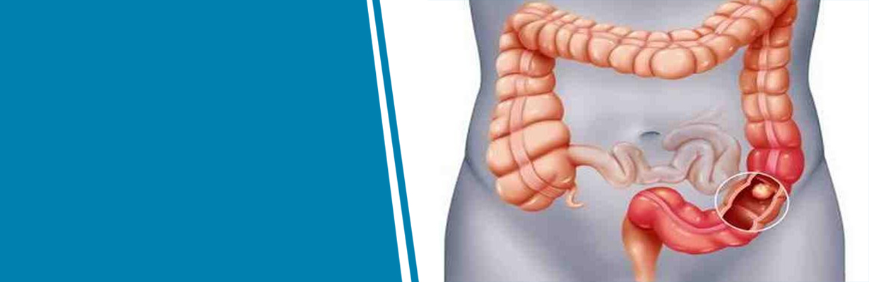How common is cancer of the colon?