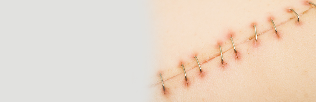 How to Heal Stitches faster?