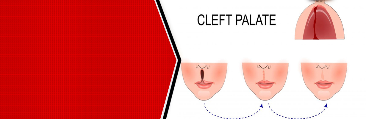 How do you treat a Cleft lip and a Cleft Palate?