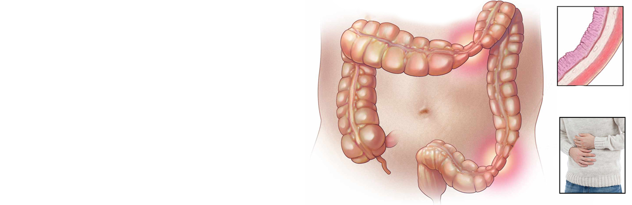 How is Irritable bowel syndrome related to stress?