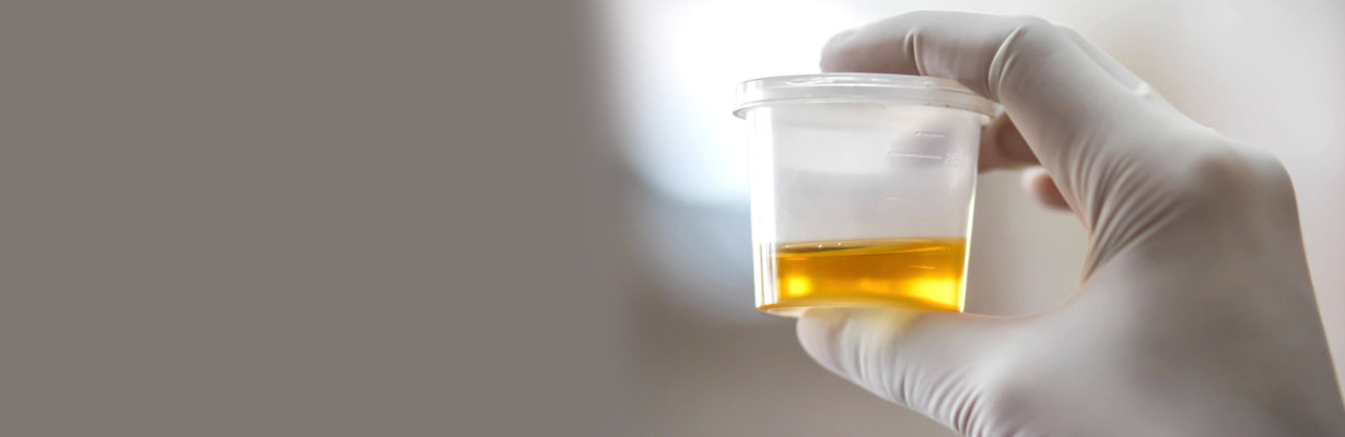 How should we collect urine for tests?