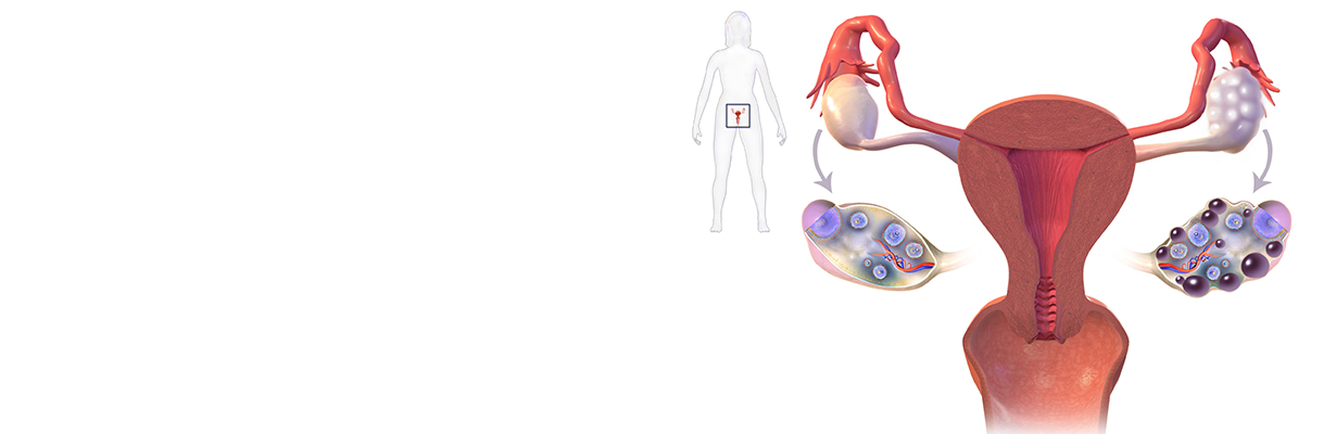 How should we proceed once we suspect PCOS?