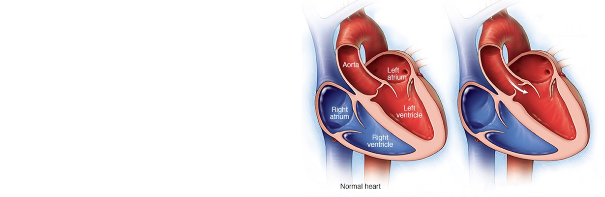 What is congenital heart disease?
