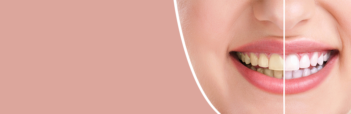 How to remove Brown Stain from Teeth