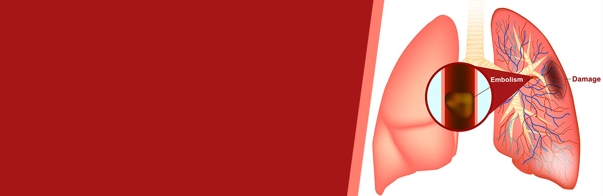 How is pulmonary embolism diagnosed?