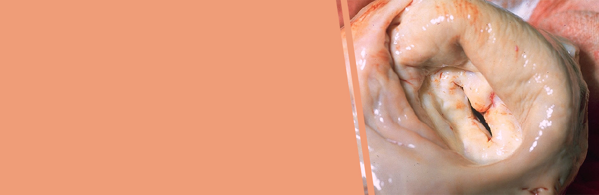 How often we follow up a patient with mitral stenosis?