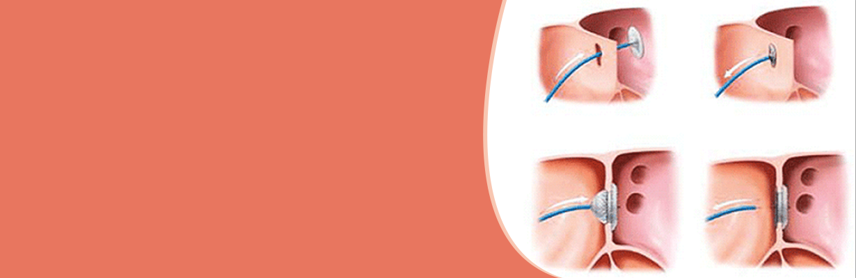 How should we differentiate PFO from ASD?