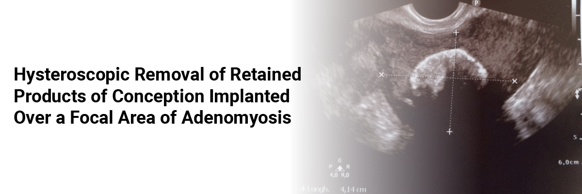 Hysteroscopic Removal of Retained Products of Conception Implanted Over a Focal Area of Adenomyosis