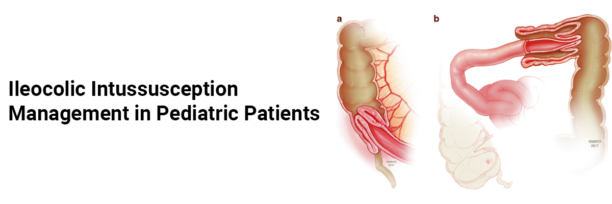 Ileocolic Intussusception Management in Pediatric Patients