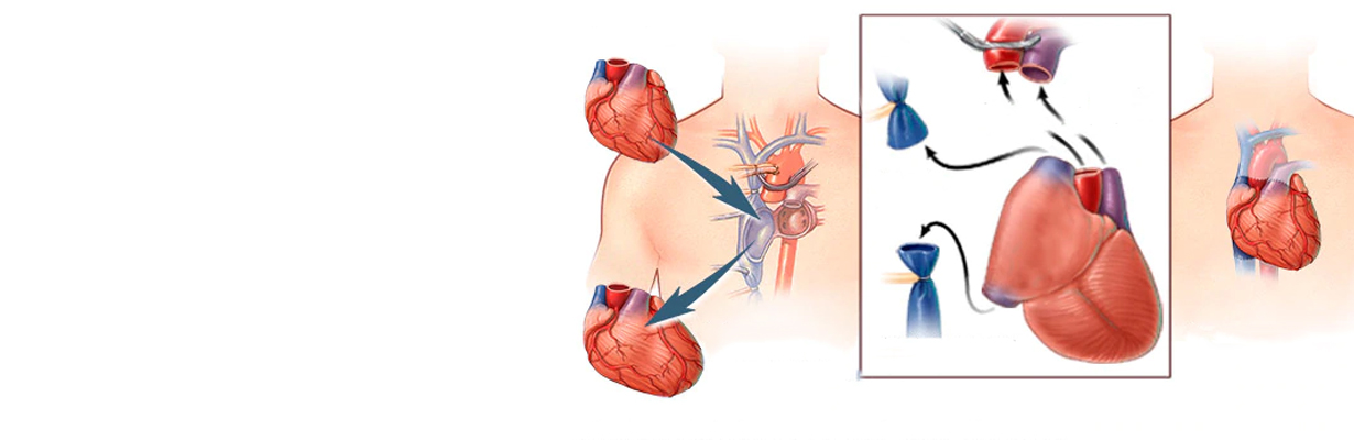 In what circumstances does a patient require cardiac transplant?