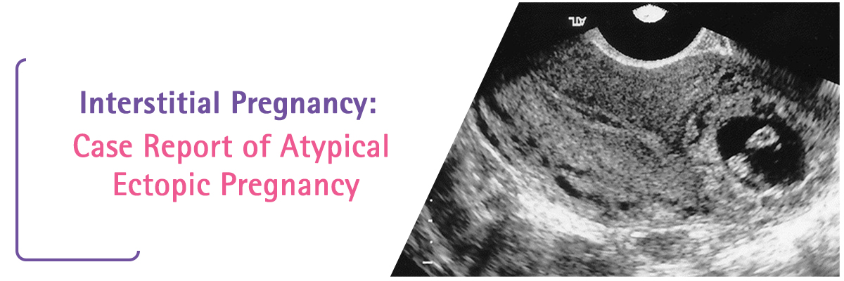 Interstitial Pregnancy: Case Report of Atypical Ectopic Pregnancy.