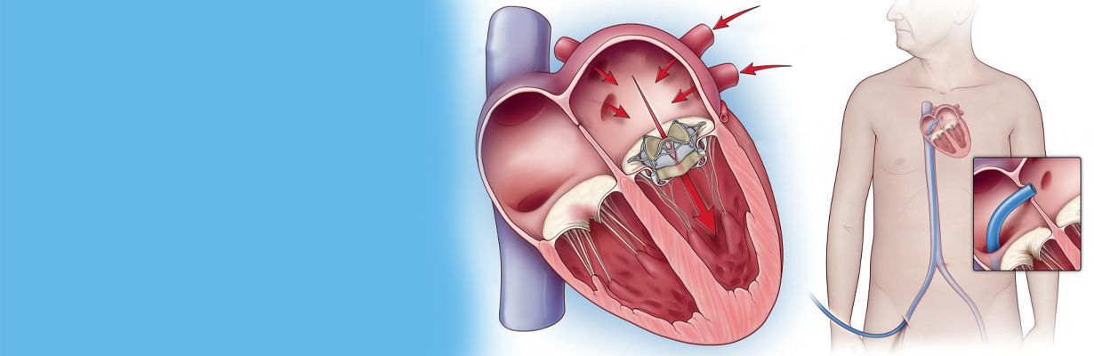 Is double valve replacement is superior to aortic valve replacement with mitral valve repair?