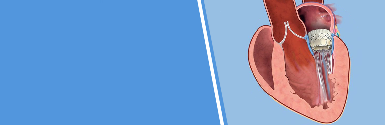 Is intervention necessary in rheumatic heart disease patient with mitral stenosis?