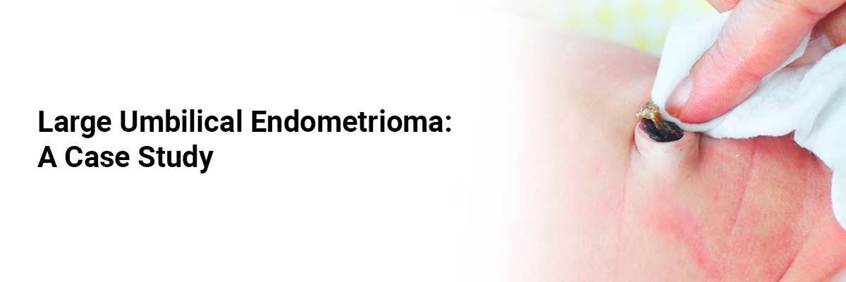 Large umbilical endometrioma: A case study
