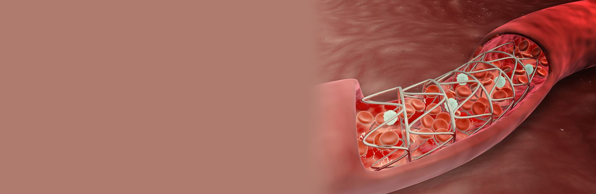 Late restenosis after primary PCI?