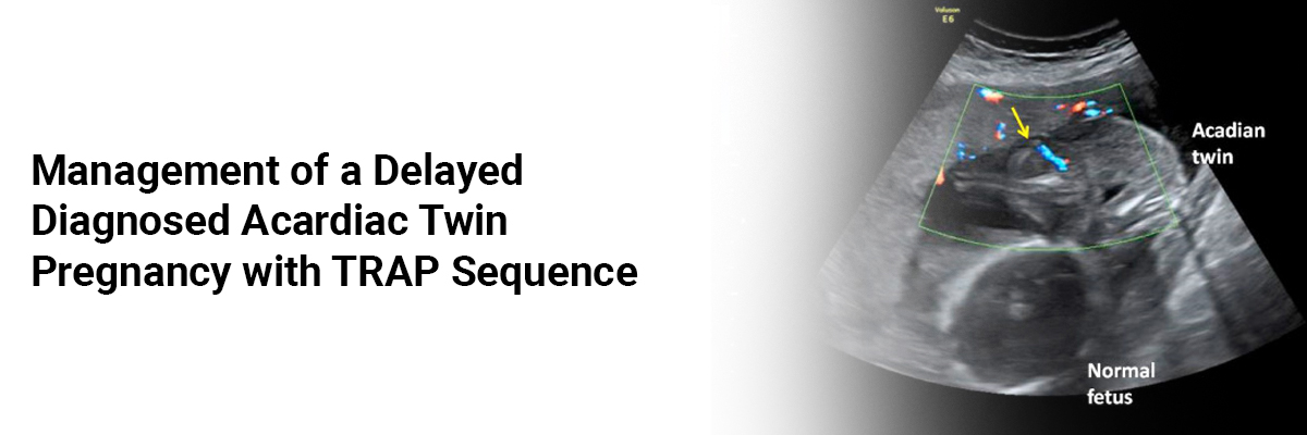 Management of a Delayed Diagnosed Acardiac Twin Pregnancy with TRAP Sequence