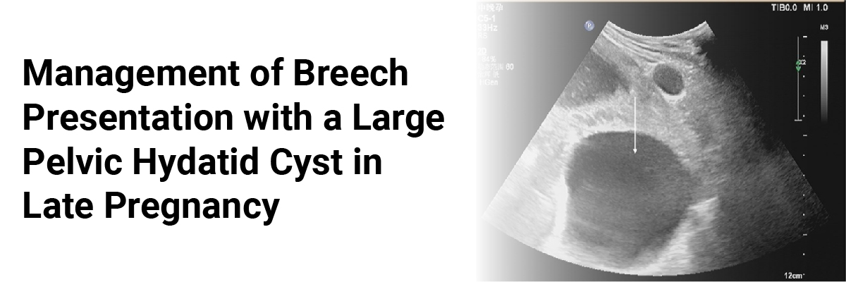 Management of breech presentation with a large pelvic hydatid cyst in late pregnancy