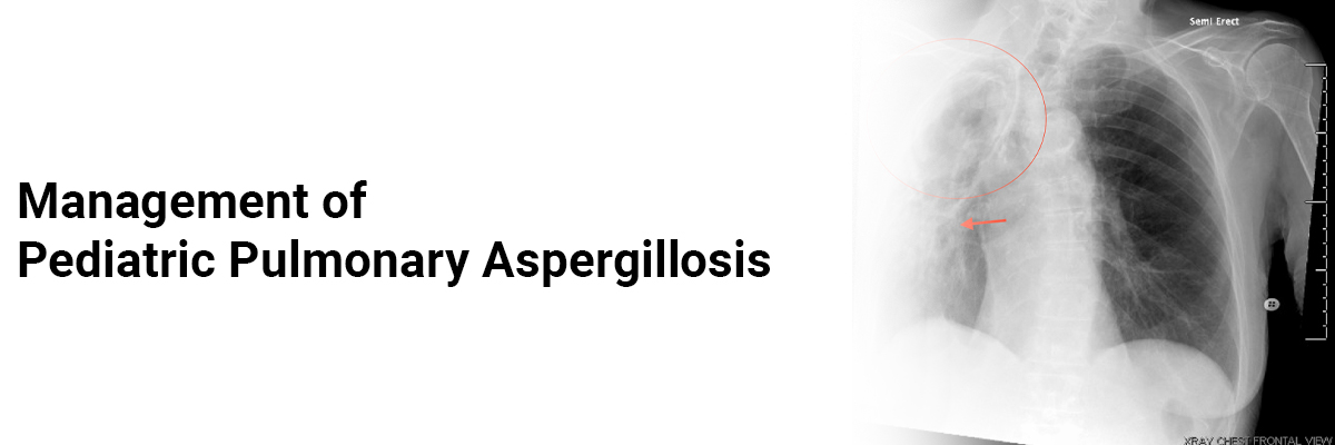 Management of pediatric pulmonary aspergillosis