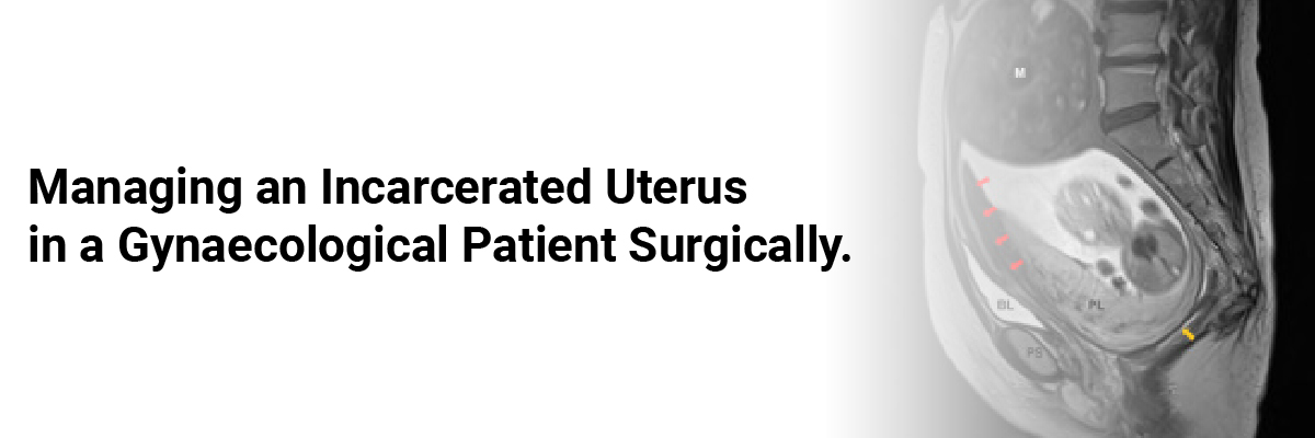 Managing an incarcerated uterus in a gynaecological patient surgically.