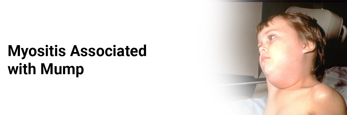 Myositis Associated with Mump