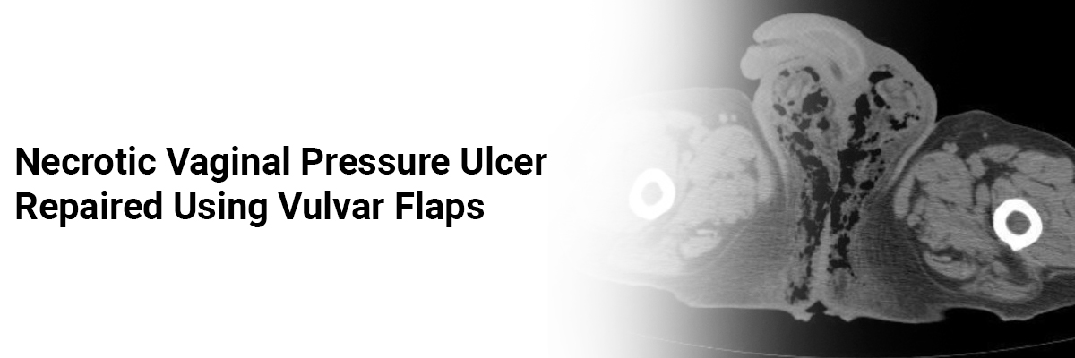 Necrotic Vaginal Pressure Ulcer Repaired Using Vulvar Flaps