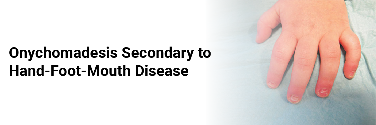 Onychomadesis secondary to hand-foot-mouth disease