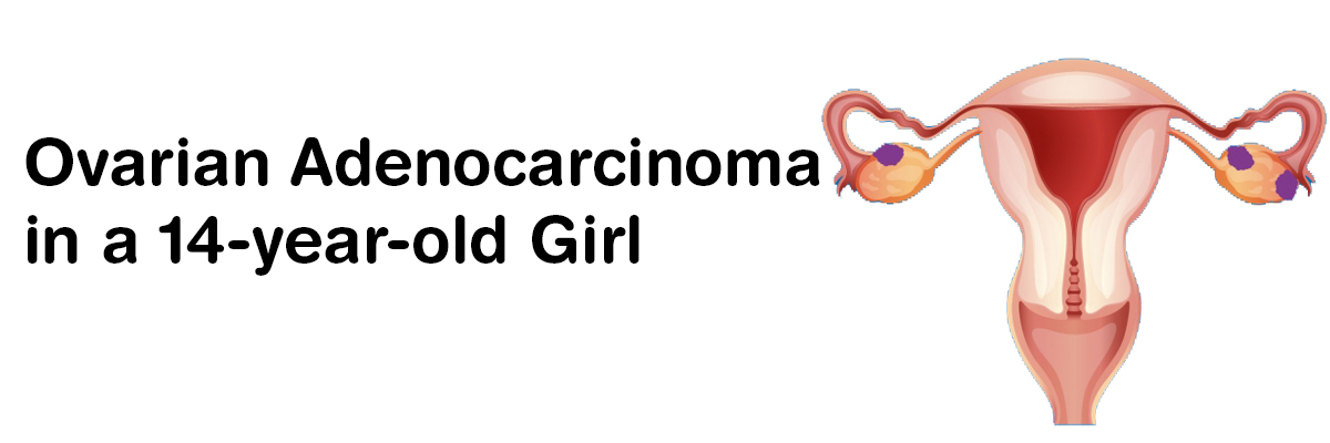 Ovarian adenocarcinoma in a 14-year-old girl