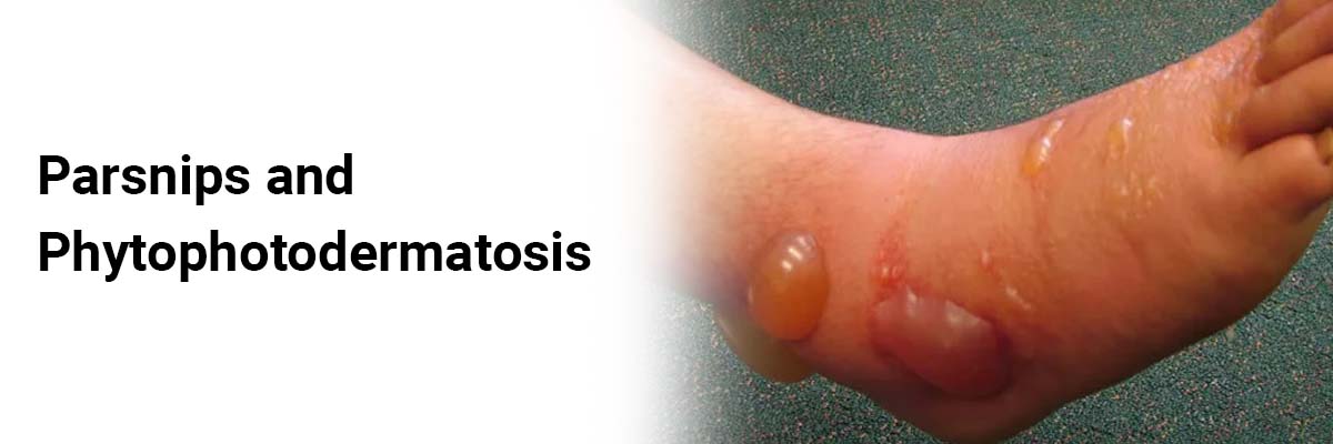 Parsnips and Phytophotodermatosis