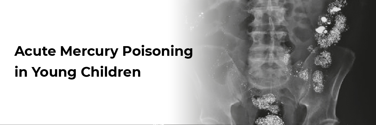 Acute Mercury Poisoning in Young Children