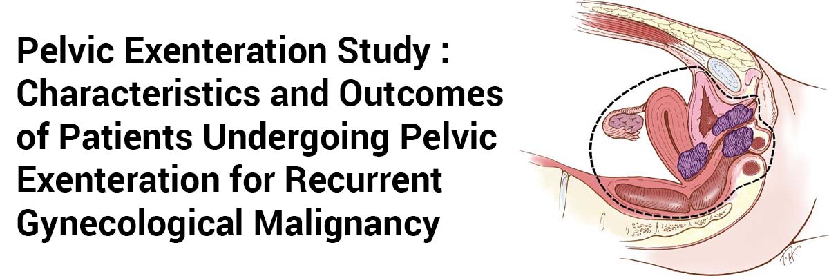 Pelvic Exenteration Study: Characteristics and Outcomes of Patients Undergoing Pelvic Exenteration for Recurrent Gynecological Malignancy